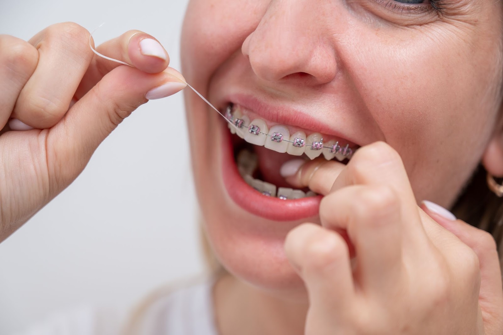 Caring for Braces in Polk County: Tips to Keep Your Smile on Track